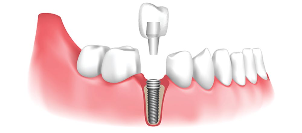 local implant dentist near you