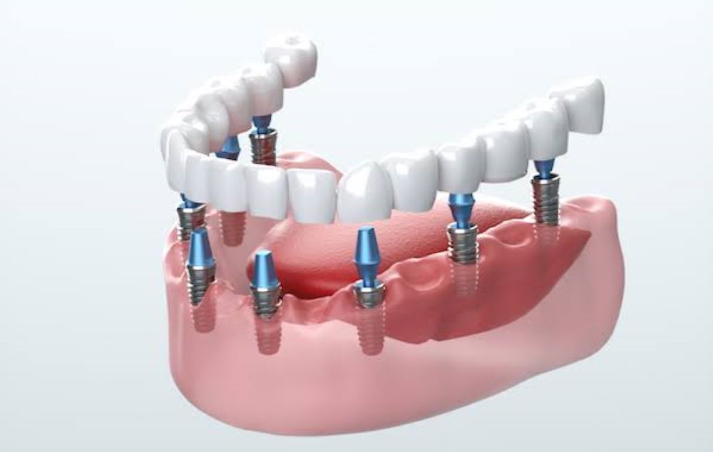 implants in Agoura Hills