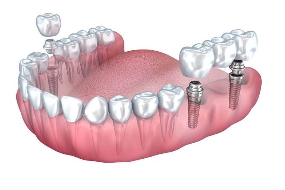 How Dental Implants in Agoura Hills Support Long-Term Oral Health